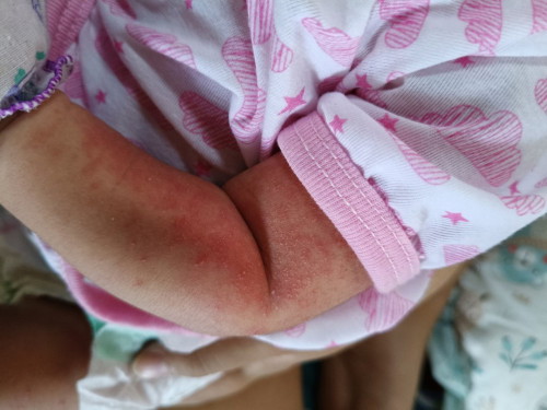 ลูกมีผดผื่นขึ้นที่แขนทั้ง2ข้าง