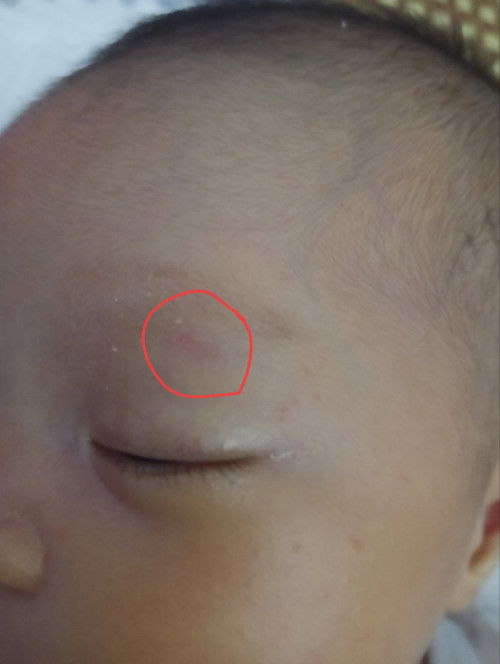 Cho e hỏi vệt đỏ ở đoạn mắt với vệt thâm thâm ở chân từ lúc đẻ mà đến giờ tháng rồi mà chưa hết.