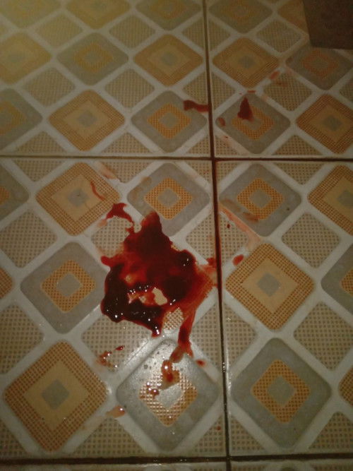 Keluar kelenjar darah seperti haid, awalnya ngeflek biasa apakah berbahaya?