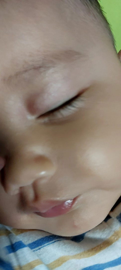 Kelopak mata bengkak