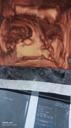 Bun kalau di liat dari hasil print USG nya normal ngga sih yaa , dokter bilang normal sih bagian wjh