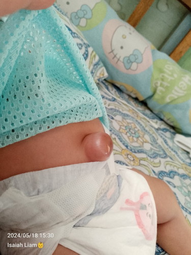 UMBILICAL HERNIA