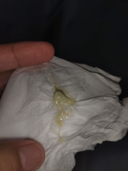 Malem bund, numpang nanya klo keputihan kaya gini bahaya ga sih bund, apkah ada yang sama kaya aku?