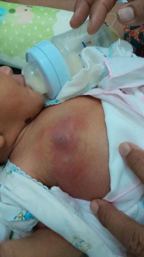 Benjolan payudara bayi