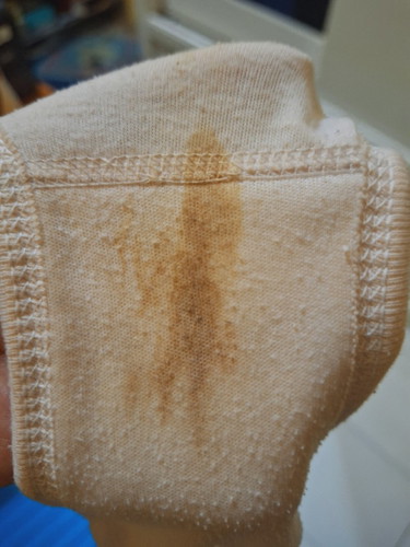 Hamil 7 minggu, Flek Coklat