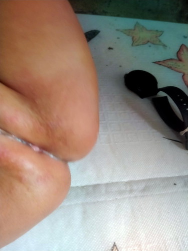 Mw nnya bun ini knpa yah hbis plg dri rs lngsung bgni ruam bkan