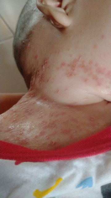 Bintik-bintik pda bayi