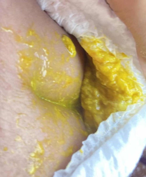 แบบนี้ท้องเสียไม่ค่ะ หรือว่าปกติ