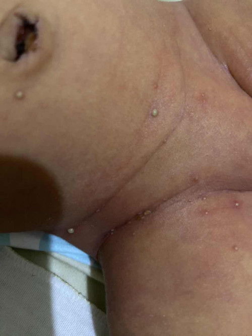 kemerahan pada newborn