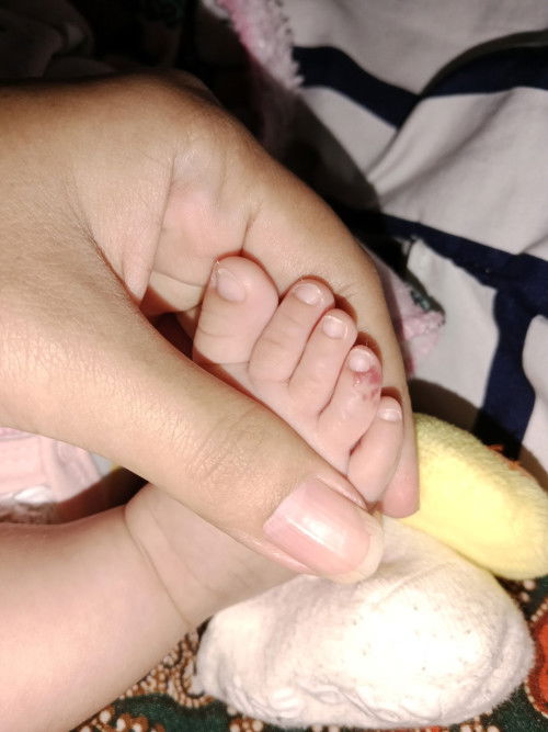 Merah di jari bayi