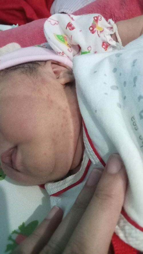 น้องเป็นผื่นแบบนี้ แม่ๆพอจะรู้ไหมงั้บผื่นอะไร น้องได้12วัน