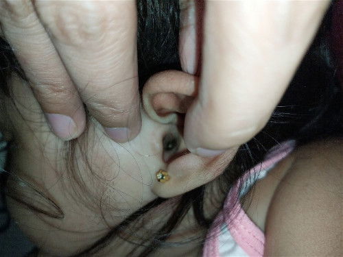 Dumi sa tainga (1year old baby girl)