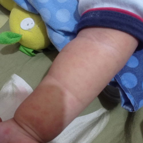 Ruam pada anak 1 tahun