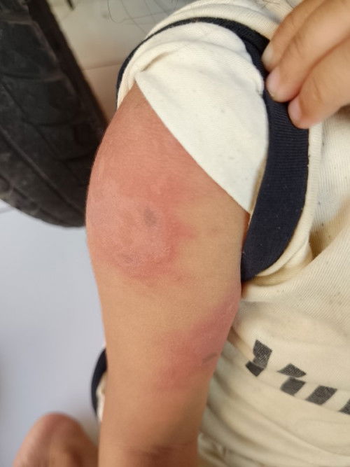 Ini kira kira cacar atau apa ya