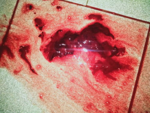 10weeks pregnant 4 days bleeding