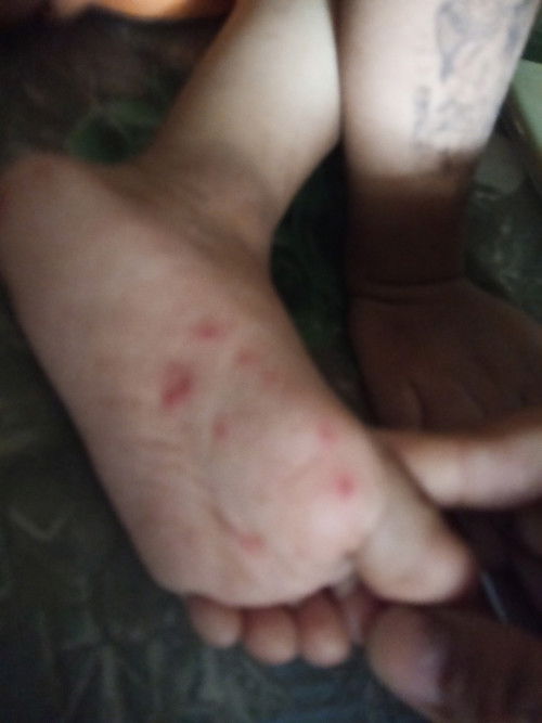 Ada ga ya yg pernah ngalamin anaknya muncul seperti ini ??  Awalnya di kaki ,