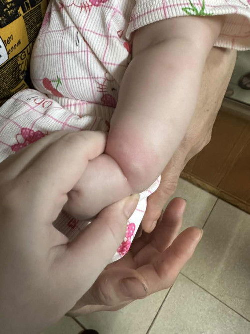 Như này là bị con gì đốt ạ?