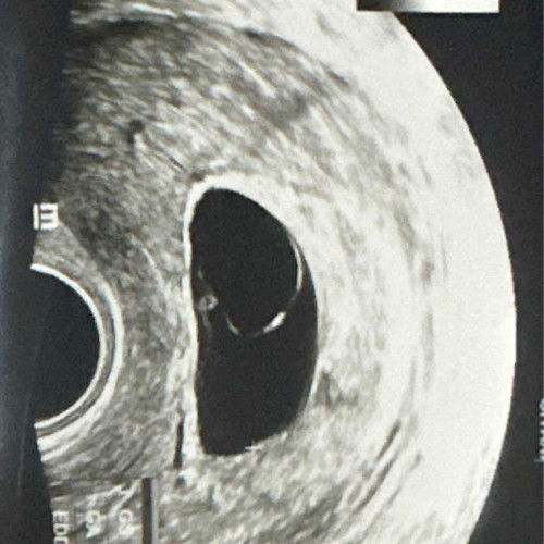 Usg 8w belum terlihat janin dinyatakan BO