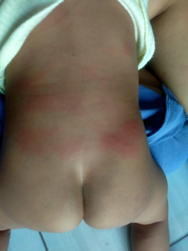 Bun anak saya 1 thn hbis transfusi darah hb rendah apa ini efek smpingnya yah