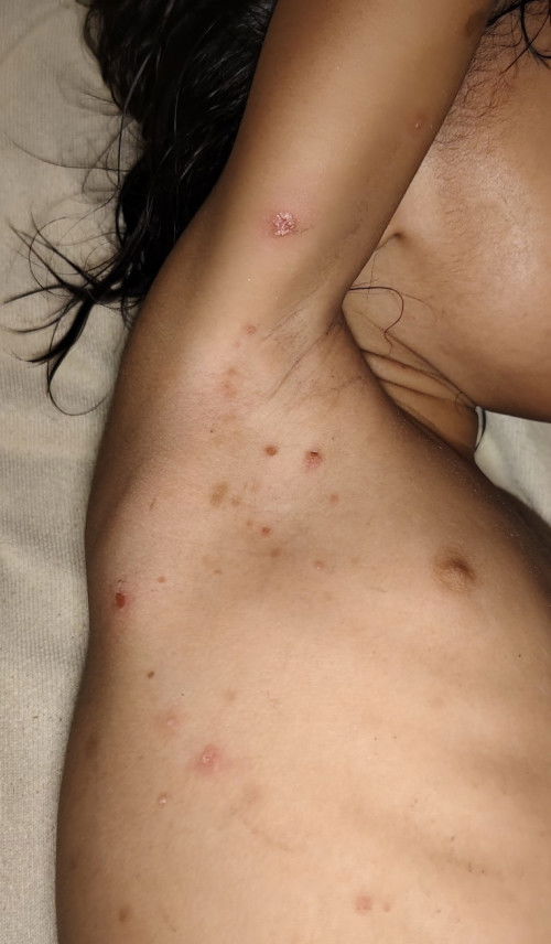 Gatal isi air seperti nanah