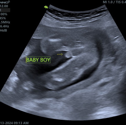 BABY's GENDER ULTRASOUND