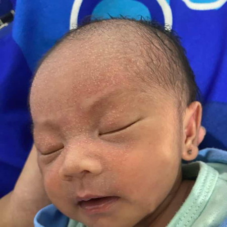 Bruntusan di muka dan kepala bayi