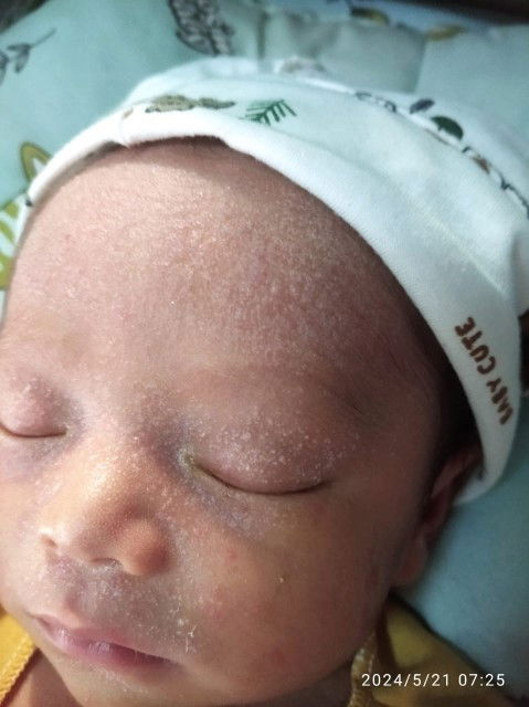 Bruntusan di dahi dan kulit kepala