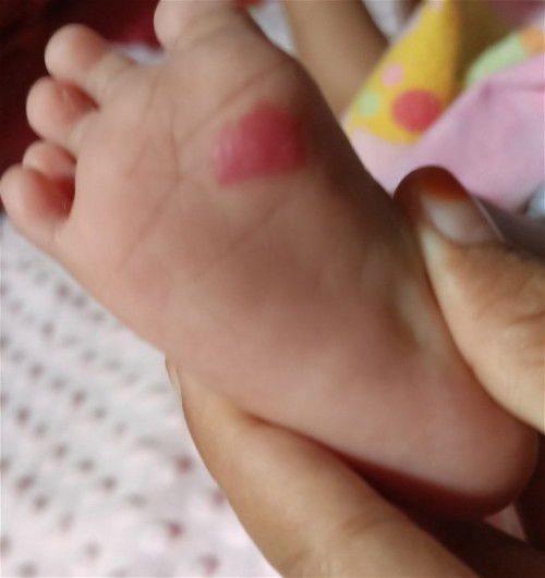 merah dikaki bayi