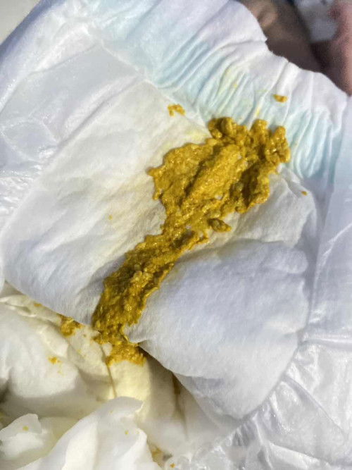 อึทารกแบบนี้ปกติไหมคะ