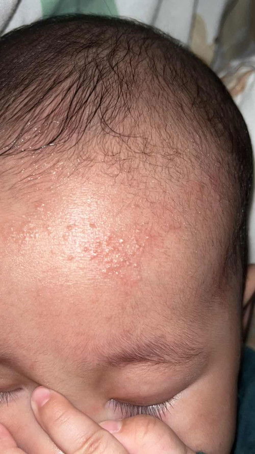 bintik2 pada wajah bayi