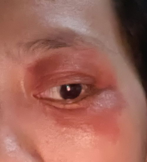 Cara menghilangkan bekas sakit dompo