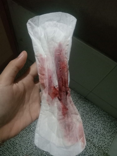 Keluar darah ketika hamil 10 minggu aman kah