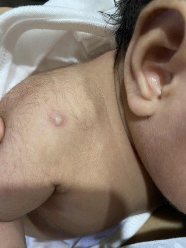 Bakuna keloid? Newborn/1month