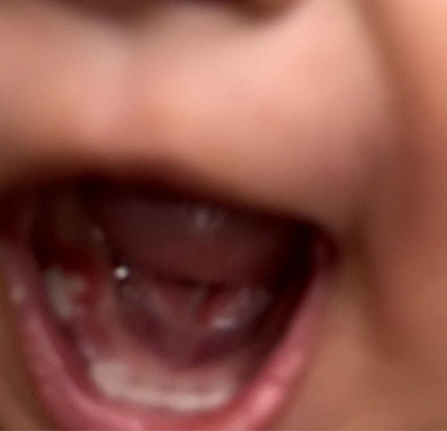 Nana sa gilagid ng ngipin ni baby