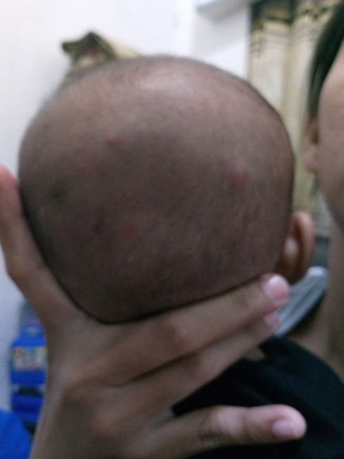 Kepala bejendol seperti bisul , cuma sepertinya tidak sakit