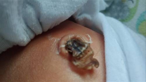 Umbilical cord
