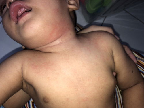 Bintik dan bentol pada kulit bayi 10 bulan