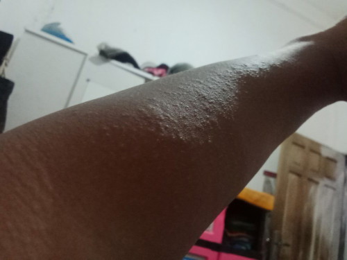 Bunda mau tanya dong,ada yg pernah ngalamin ky gini gk,kulit bintik2 kecil banyak,gatal,perih,k