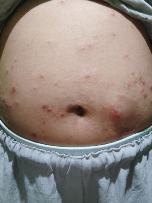 RASHES in Pregnancy??
