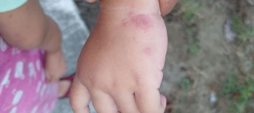 Muncul bintik lalu melebar