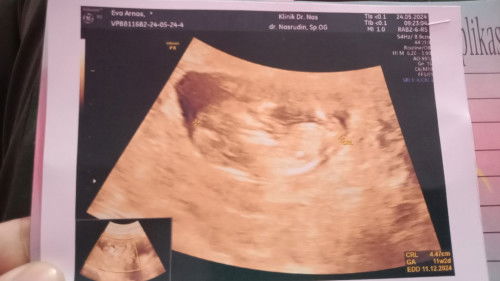 Hitungan HPHT dan USG beda