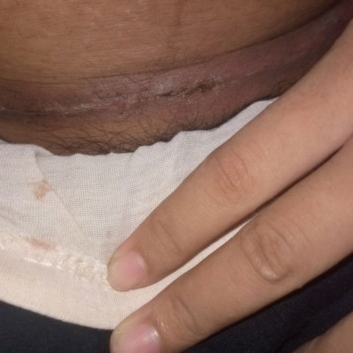 Luka setelah melahirkan secara sc