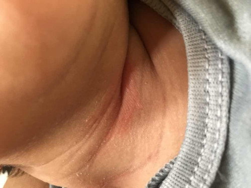 Kenapa ada merah merah di leher bayi