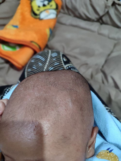 BENJOLAN LEMBEK DI KEPALA