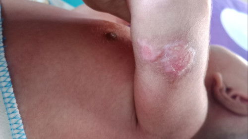 Beruntusan pada kulit bayi