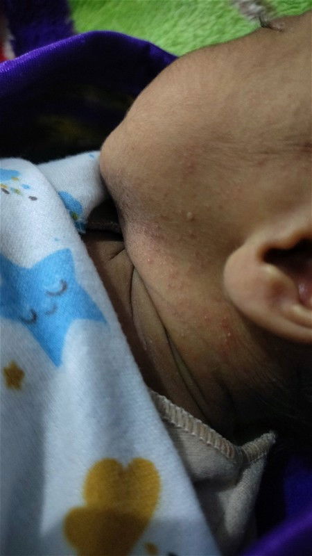 Merah merah pada kulit bayi