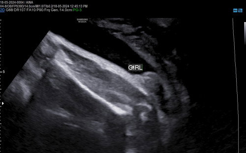 Gender baby