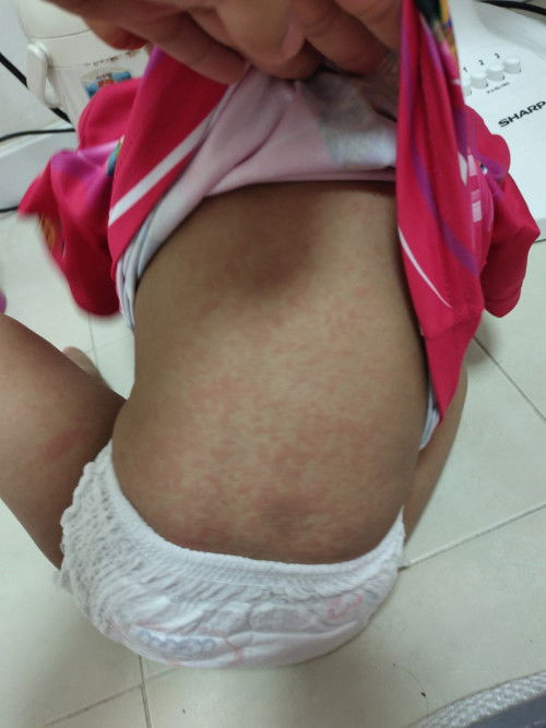 ผื่นหรือเปล่า