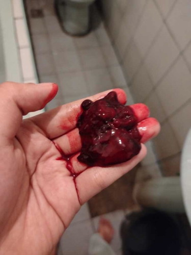Dalawang beses nilabasan ng buong dugo