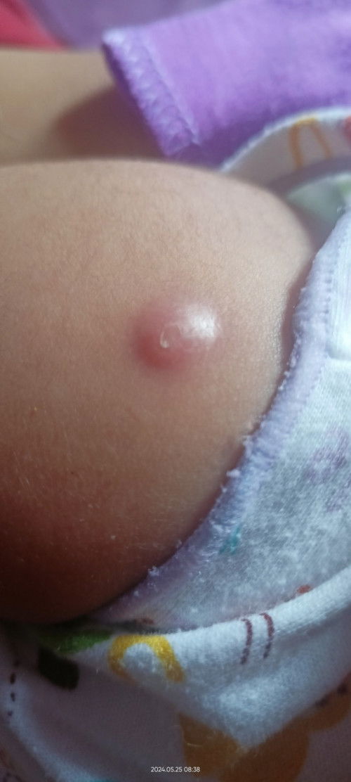 Bekas BCG seperti bisul baby 2.5bln